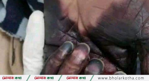 সাবধান চট্টগ্রাম মেডিকেলে প্রথমবারের মতো ব্ল্যাক ফাঙ্গাস শনাক্ত।